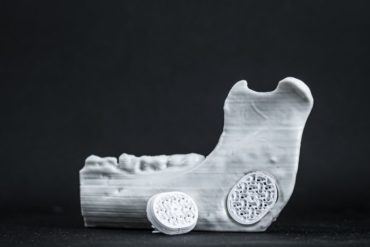 Ein Knochen-Implantat von Particle3D füllt eine Lücke in einem echten Knochen